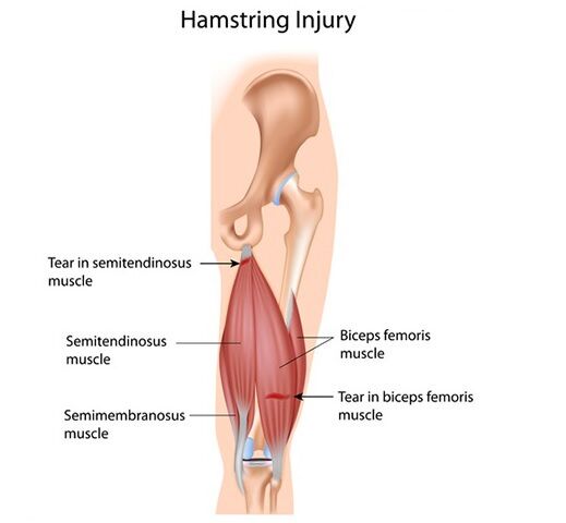 What is a good way to treat a hamstring injury?